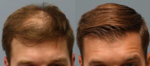 Hair transplant specialist planning treatment for fuller hair appearance