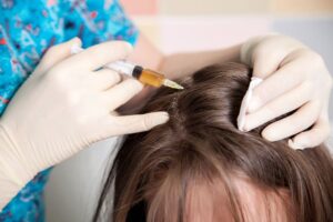 Hair transplant grafts being prepared and implanted for natural-looking hair restoration