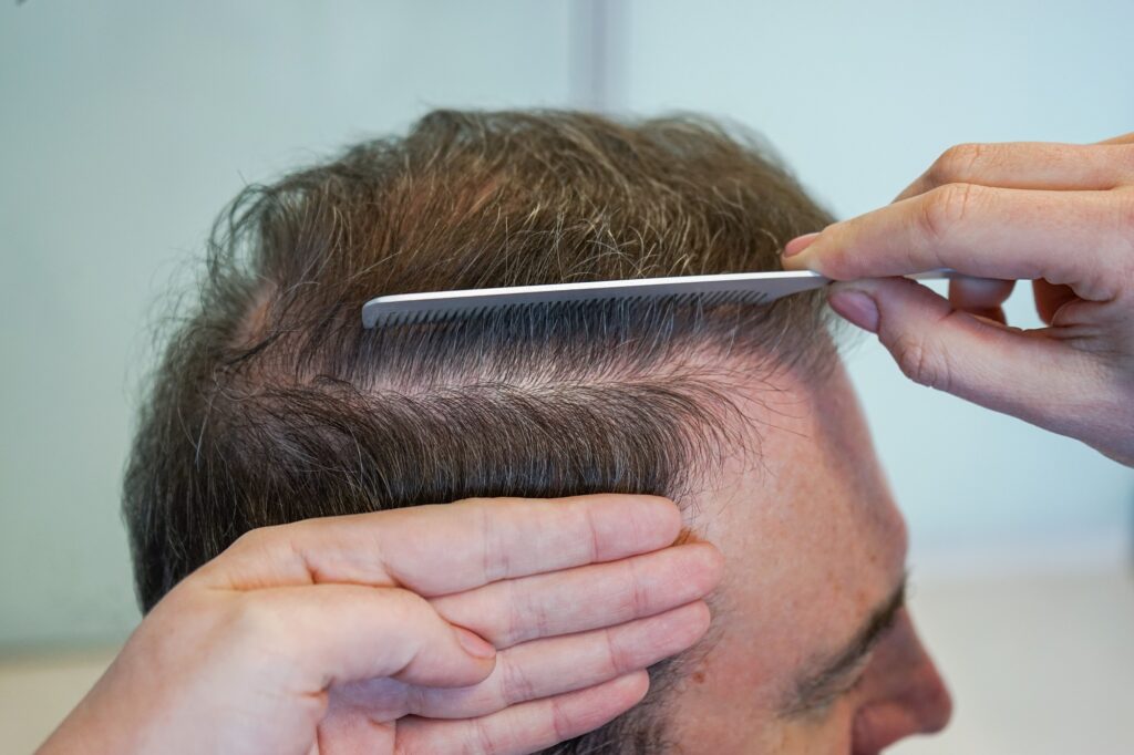 Patient following proper aftercare instructions to protect hair grafts during hair transplant recovery.