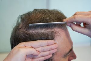 Patient following proper aftercare instructions to protect hair grafts during hair transplant recovery.