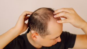Man experiencing baldness and considering hair restoration treatment for fuller hair.