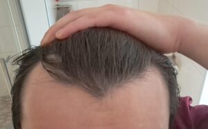Patient reviewing new hairline results after hair transplant