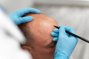 Hair transplant treatment for permanent hair loss
